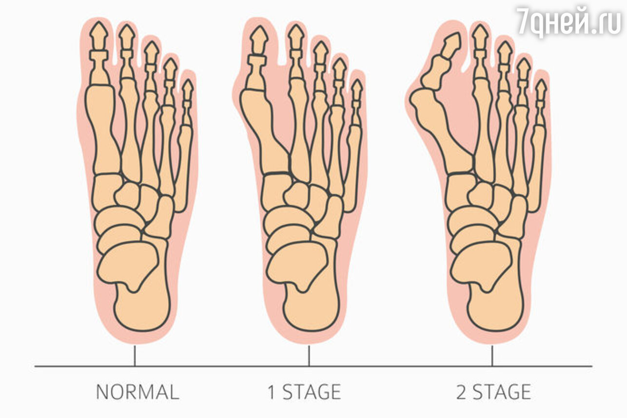 Hallux valgus